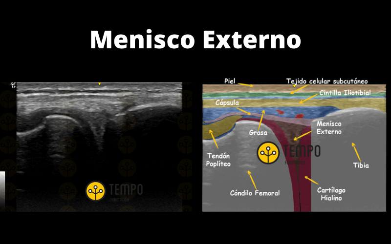 8. Menisco Externo Ecografia Tempo Formacion.png